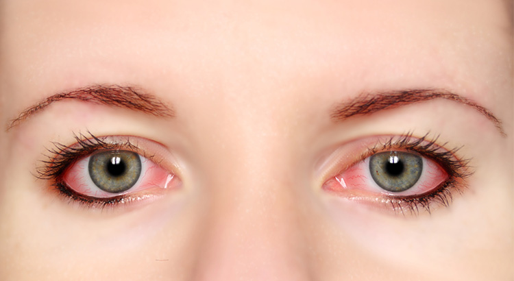 conjuntivitis_Farmacia_Almerimar_farmaciaalmerimar.es_farmacias.com